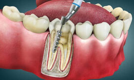 What Is a Root Canal? Is It Safe or Dangerous ?