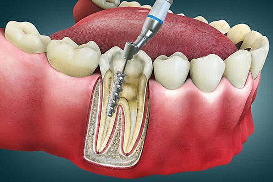 what is a root canal